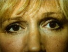 Eyelid Surgery Patient 67593 Photo 2