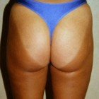Liposuction Patient 95034 Photo 2