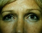 Eyelid Surgery Patient 67593 Photo 1